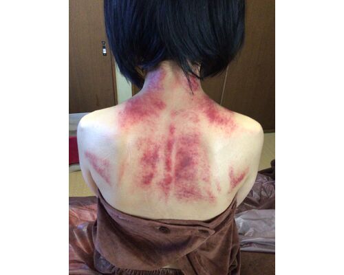 かっさで瘀血をデトックス