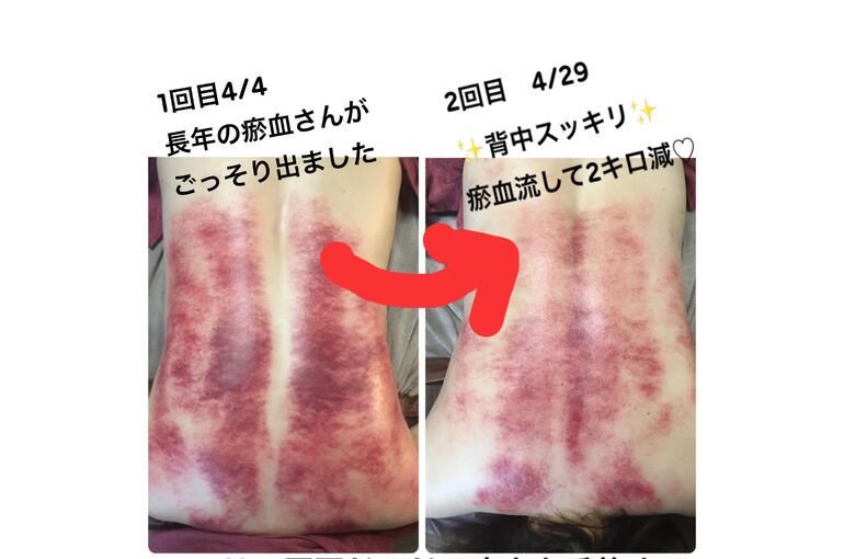 【浦和　かっさ】ドロドロ瘀血をブシャーっとデトックス！新アイテム導入♪